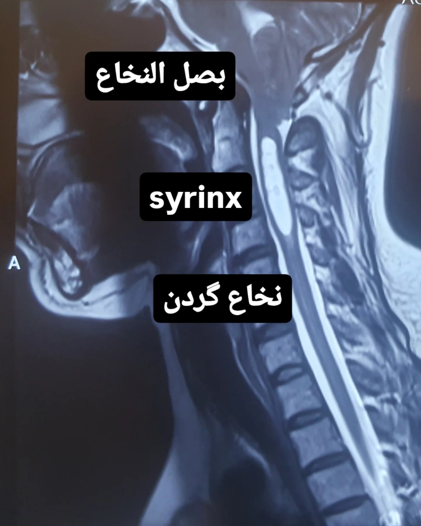 تصویربرداری مغز — سندروم کیاری و پایین‌آمدگی مخچه