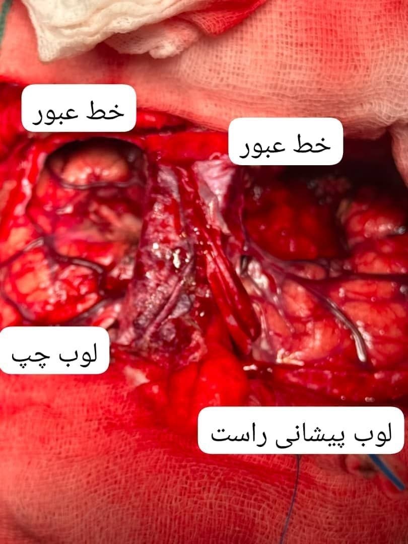 نمای جراحی پیش از برداشتن ضایعه