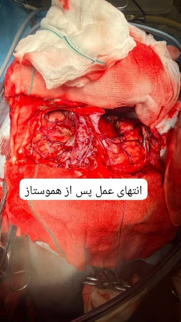 نمای جراحی پس از پایان عمل