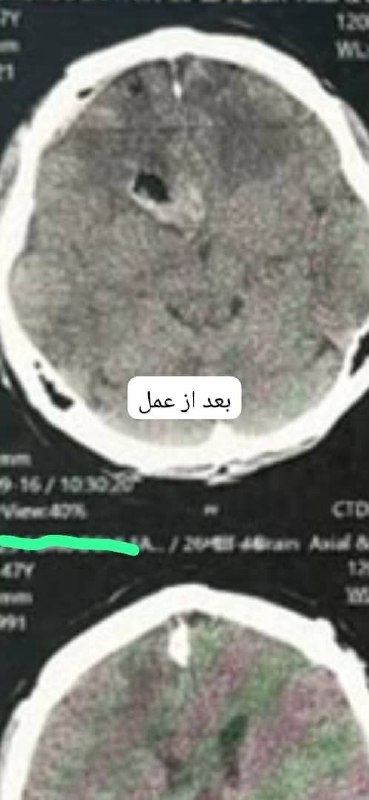 تصویربرداری پس از عمل — وضعیت مغز پس از تخلیه ضایعه