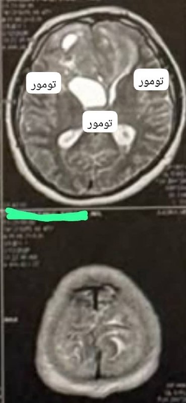 تصویربرداری پیش از عمل — ضایعه منتشر لوب پیشانی دوطرفه