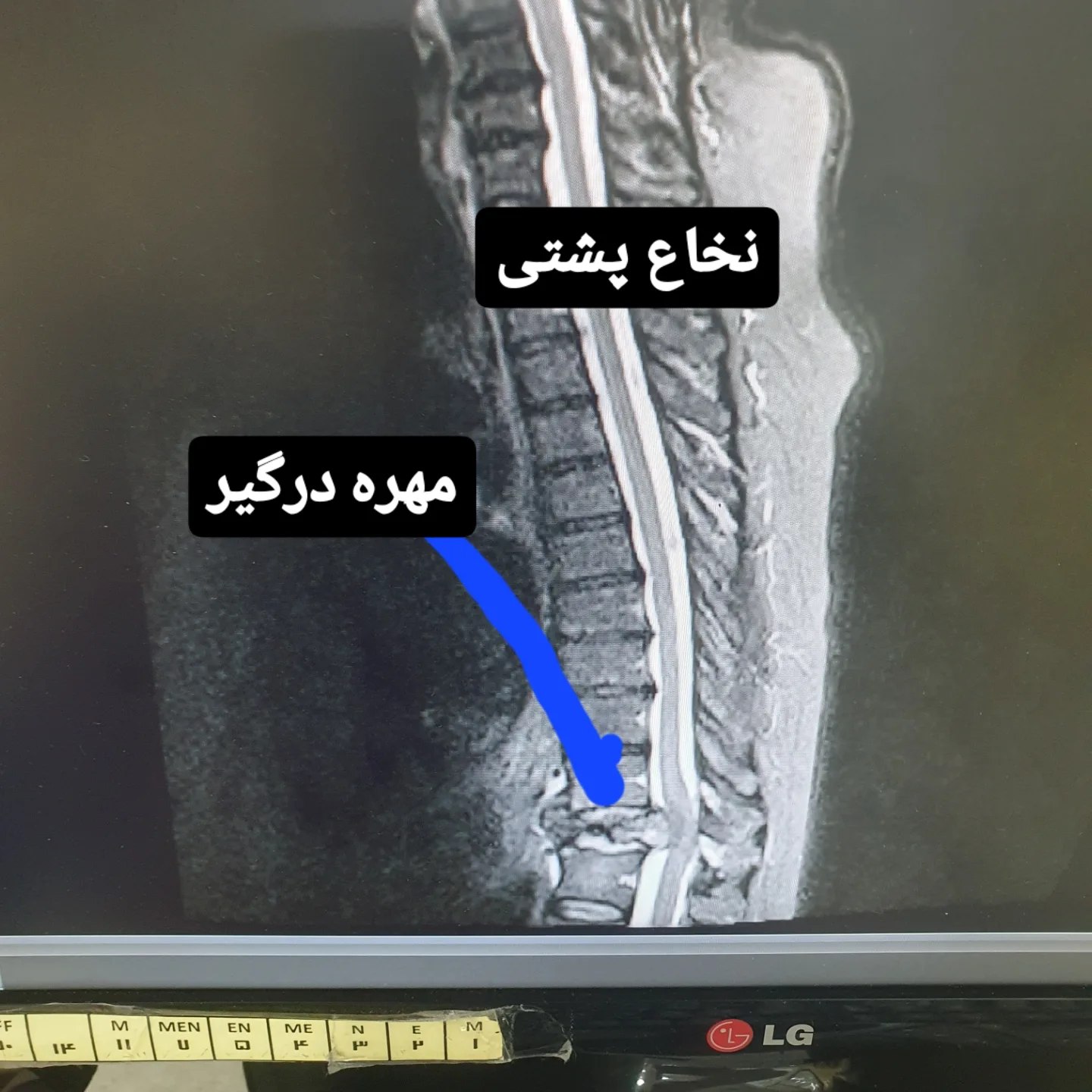 تصویربرداری ستون فقرات — شکستگی مهره و فیوژن جراحی‌شده